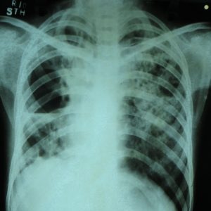 Röntgenthorax mit Tuberkulose - Foto: Dr. Sohn