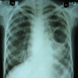 Röntgen-Thorax mit Kaverne bei Tuberkulose Aufnahme: Dr. Sohn