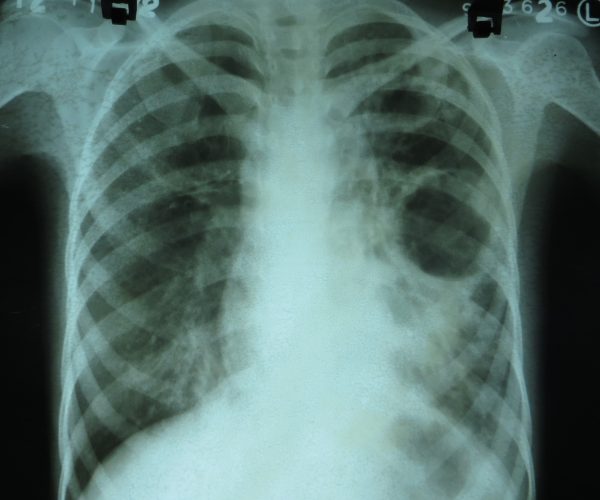 Röntgen-Thorax mit Kaverne bei Tuberkulose Aufnahme: Dr. Sohn